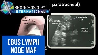 EBUS Lymph Node Map  Nodal Anatomy [upl. by Arte697]