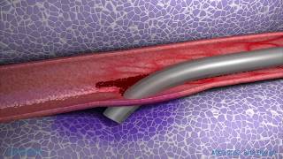 Peripheral IV Infiltration Animation [upl. by Kegan]