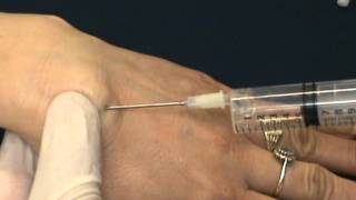 wrist ganglion aspiration [upl. by Vinson]