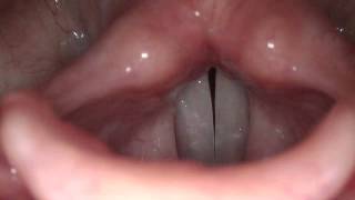 Stroboscopy Normal Female Vocal Cords [upl. by Aihsei669]