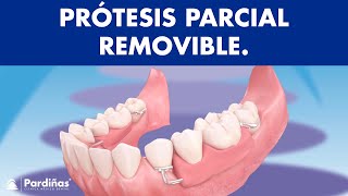 Prótesis parcial removible  ¿Cómo funcionan © [upl. by Etnoval]
