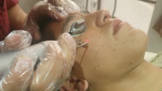 Freckles treatment with laser by Dr Syed Bilal Shams dermatologist and Cosmetologist [upl. by Pius830]