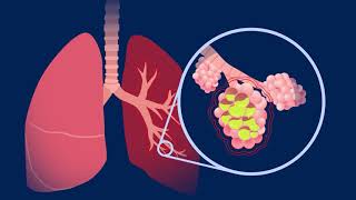 Understanding Pneumococcal Pneumonia [upl. by Amari]