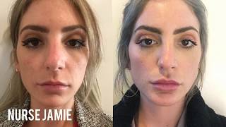 Before and After Micro Needling  Nurse Jamie [upl. by Yesak]