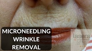 Microneedling for skin rejuvenation [upl. by Elvera]