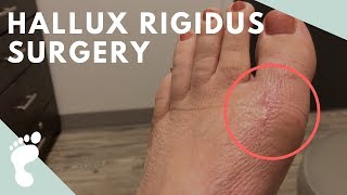 Hallux Rigidus Surgery [upl. by Theodora]