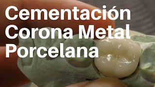 CORONA 👅 METAL PORCELANA Cementación coronadental [upl. by Anreval]