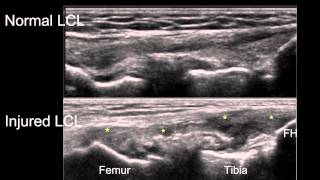 Sonographic Examination of Knee Ligaments [upl. by Tomlin]