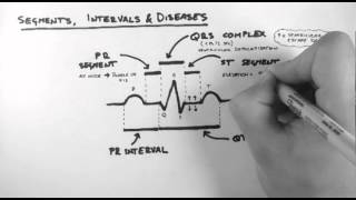 ECG 3  Segments Intervals amp Diseases [upl. by Ecyac]