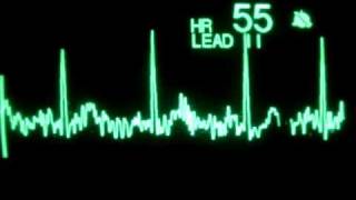 Junctional Rhythms  EKG Interpretation  LevelUpRN [upl. by Asiral474]