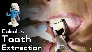 Calculus Tooth Extraction [upl. by Odnuges]