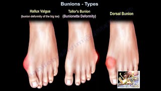 Bunions Types  Everything You Need To Know  Dr Nabil Ebraheim [upl. by Aronid]