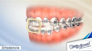 Corrección de mordida y espacios dentales quotOrtodonciaquot [upl. by Tony]