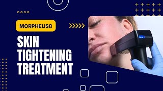 Morpheus8  Skin Tightening Treatment  West Hollywood CA  Dr Jason Emer [upl. by Tullus]