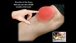 Knee Bursitis  Everything You Need To Know  Dr Nabil Ebraheim [upl. by Rodie]