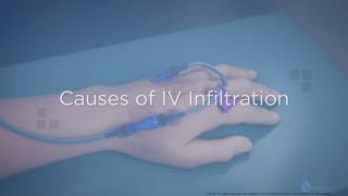 Causes of IV Infiltration  Training Video [upl. by Leal936]