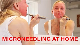 Microneedling DIY at Home  Tips Warnings and Demo  Over 50 [upl. by Oryaj]