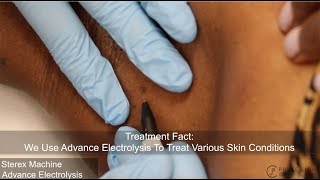 Skin Tag Electrolysis Procedure at Pulse Light Clinic London [upl. by Sualkin11]