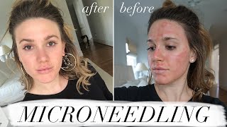 MY FIRST MICRONEEDLING EXPERIENCE amp WHAT TO EXPECT ACNE SCAR TREATMENT [upl. by Manup]