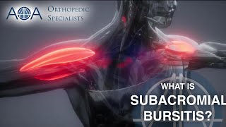 AOA Orthopedic Specialists  Subacromial Bursitis [upl. by Hsemin607]