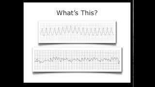 ECG Heart Rhythm Review [upl. by Popele]